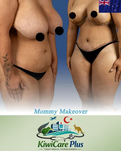 Plastic Surgery Turkey