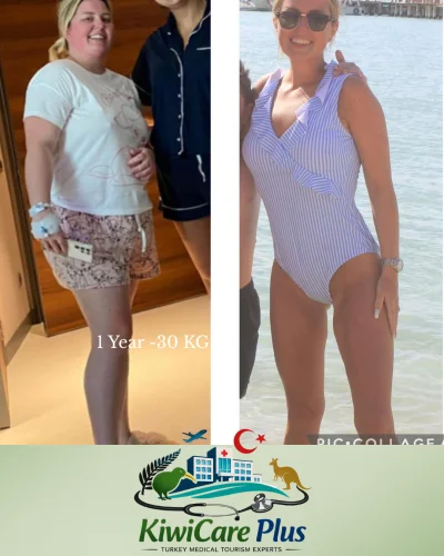 Weight Loss Surgery Turkey